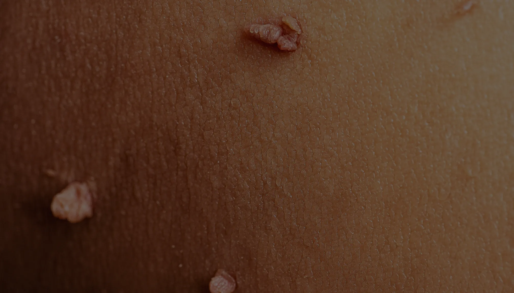 genital-sigil-hpv